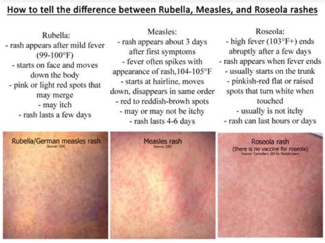 9 Crucial Differences Between Measles and Roseola Explained