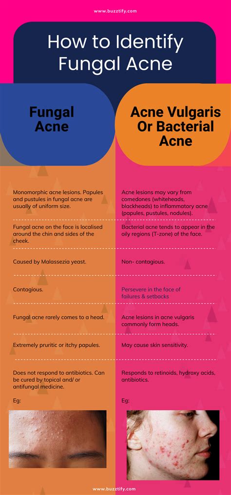 9 Essential Differences Between Fungal Acne and Pimples Explained