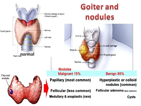 9 Essential Differences Between Goiter and Mumps Explained