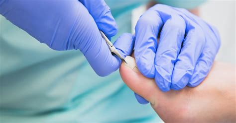 9 Essential Tips for Treating Toenail Fungus Effectively