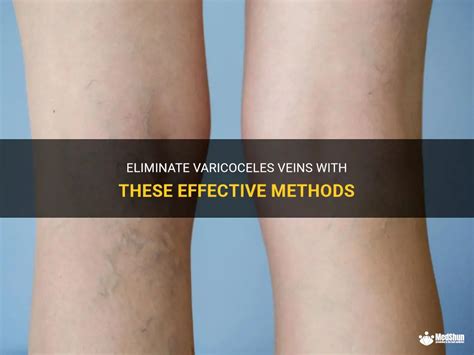 9 Innovative Methods to Prevent Varicoceles and Boost Health