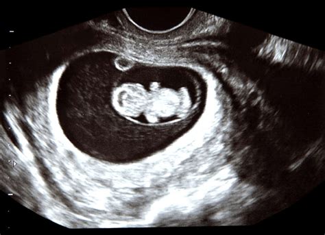 9 week sonogram fetal development