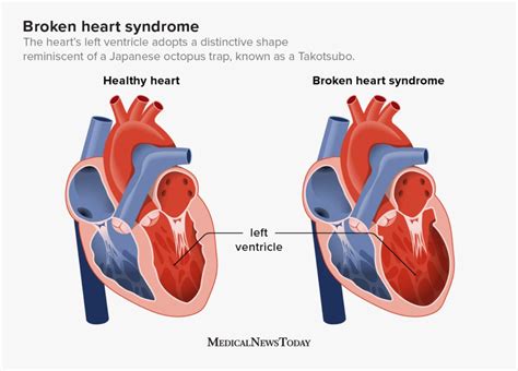A Broken Heart