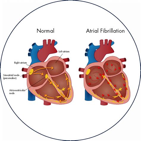 Atrial Fibrillation H… 