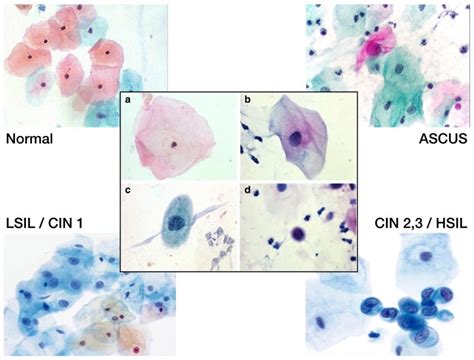 ASC-US Cytology Test and interpretation