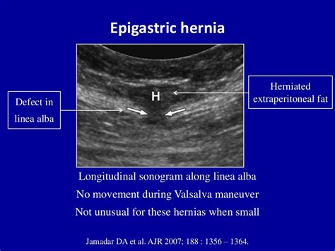 Ultrasound of the abdominal wall hernias