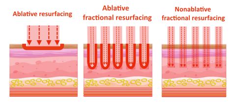 Ablative Lasers vs. Non-Ablative Lasers