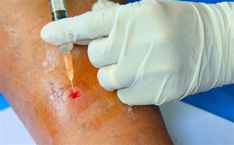Abscess Surgery: Fast Relief & Recovery