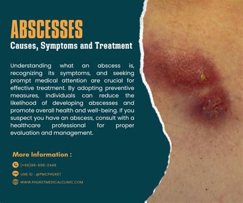 Abscesses: Causes, Symptoms & Fast Relief