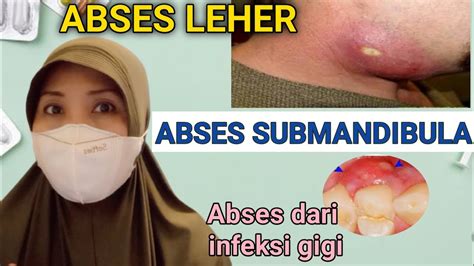 Abses Submandibula: Gejala & Cara Mengatasi