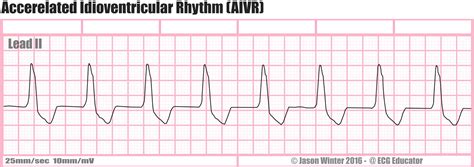 Idioventricular Rhythm EKG
