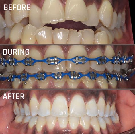 Accessing the Tooth with Braces