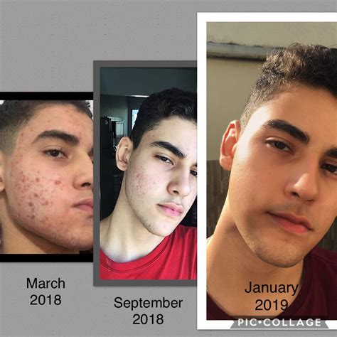 Accutane And Tattoos