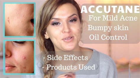 Say Goodbye to Oily Skin Woes with Accutane: The Miracle Solution You've Been Searching For!