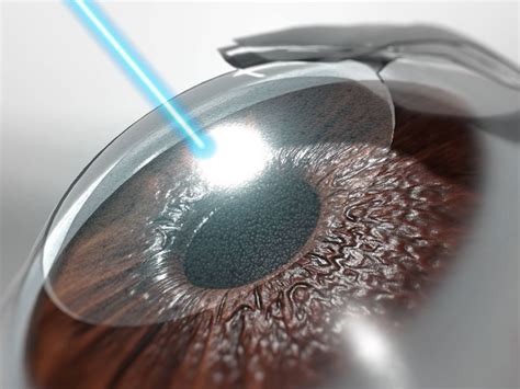 Achieving Perfect Vision: Laser and Refractive Surgery