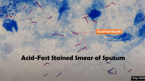 Acid-Fast Bacilli Smear Test and interpretation