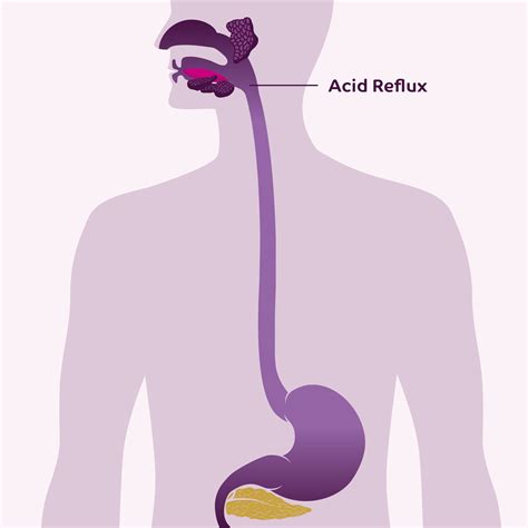 Acidity Reflux