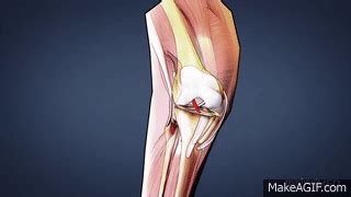 Acl Tear Gif