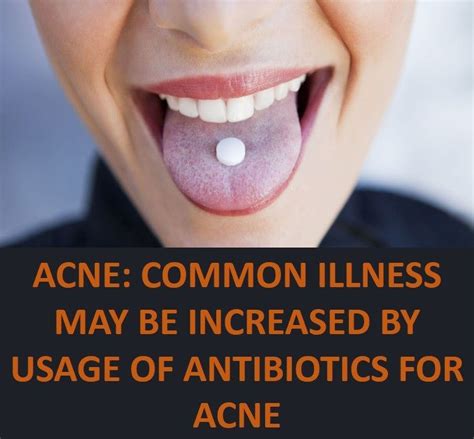 Acne Common Illness May Be Increased By Usage of Antibiotics for Acne