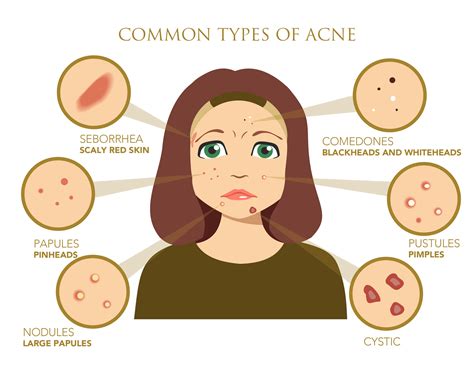 What Causes Acne? Role Of Skin Care Products And Cosmetics