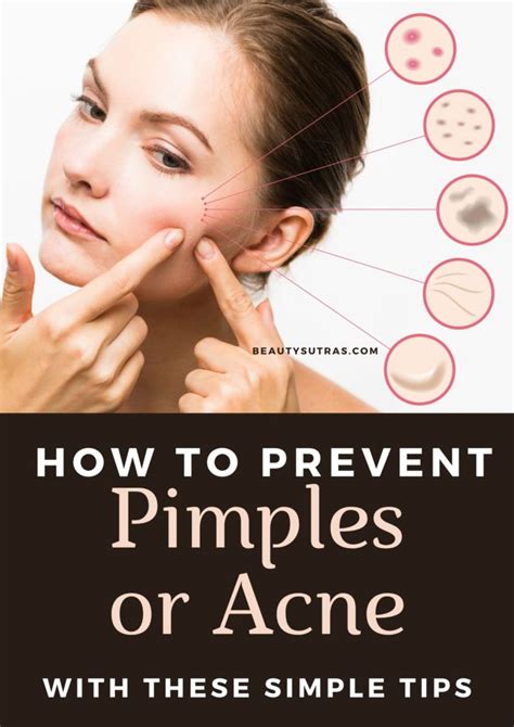BACK ACNE REMEDIES Fight Back Acne Naturally The Natural DIY in 2021