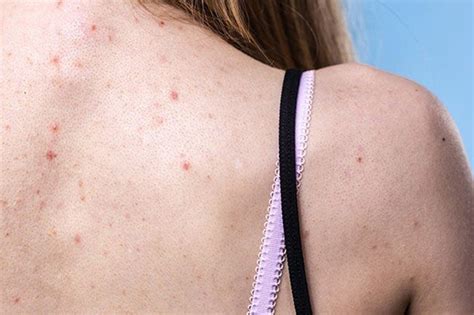 Acne Back Breakouts What’s The Deal With Acne On Your Back Back