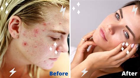 Acne Not Just A Problem For Teenagers HealthPointUS YouTube