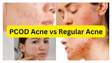 Types of Acne, Causes, and Treatment (Infographic) Tips for Natural