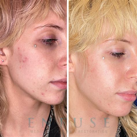 Laser Acne Treatment Expert of East Brunswick, Central New Jersey