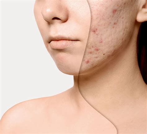 Acne Scarring Acne Scarring Treatment Wentworth Aesthetics