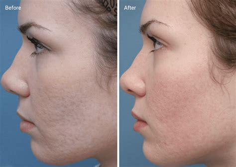 Affordable Chemical Peels For Acne Scars Before And After [2021
