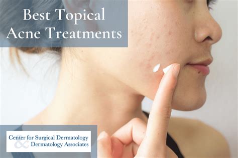 Plagued by Spots and Pimples? Help is at Hand with Some Useful Acne