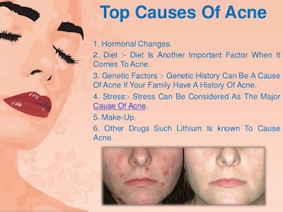 Acne Treatments A Brief Users Guide For Parents, Teens And The Rest Of