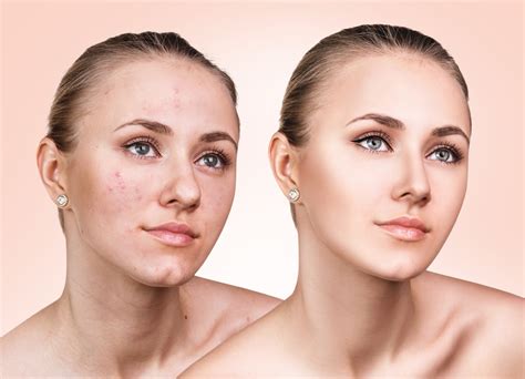 Acne Treatment Skin Care