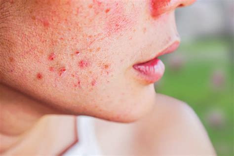 Acne-Prone