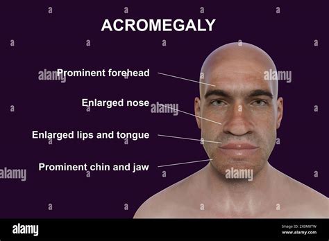 Acromegaly