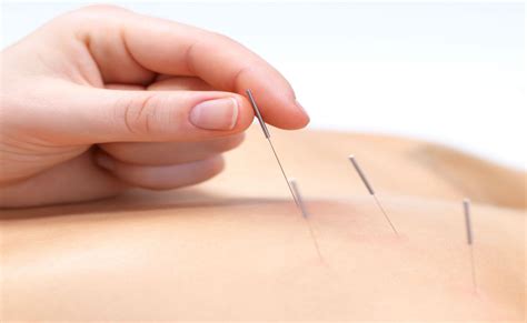 Acupuncture needles