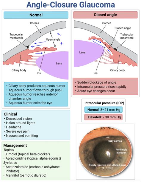 Acute Angle-Closure Glaucoma