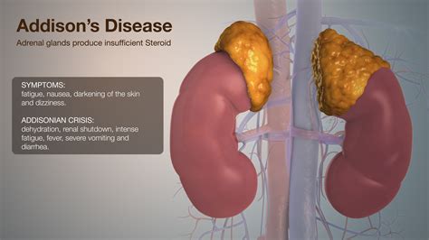 Addison Disease