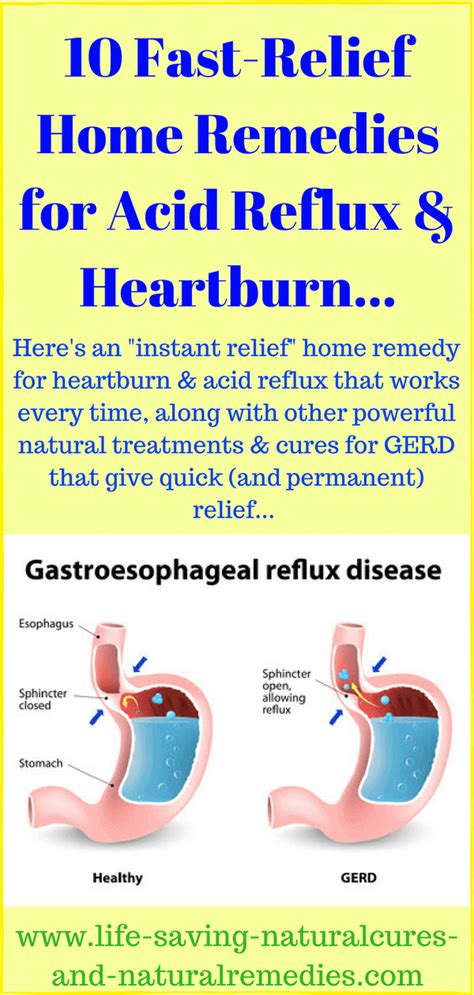 Additional Tips for GERD Relief