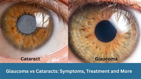Addressing Cataracts and Glaucoma