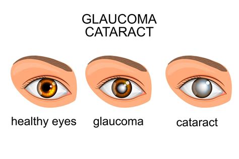 Addressing Glaucoma and Cataracts