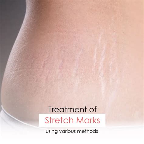 Addressing Stretch Marks