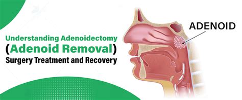 Adenoidectomy: Relief, Recovery & What to Expect.