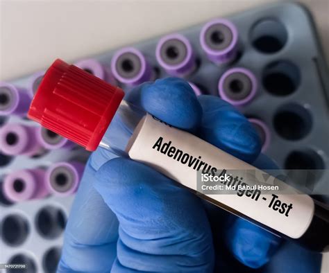 Adenovirus PCR Test and interpretation