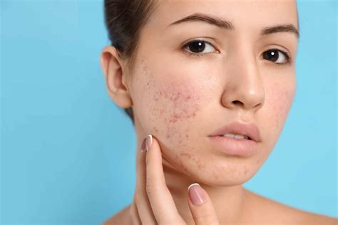 The Frustrating Causes of Adult Acne, Explained