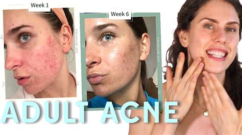 How To Deal With Adult Acne