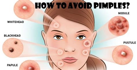 Dont let acne advance Acne, Acne help, Prevent acne