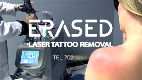 Laser Tattoo Removal Treatment Tvaksh Advanced Skin