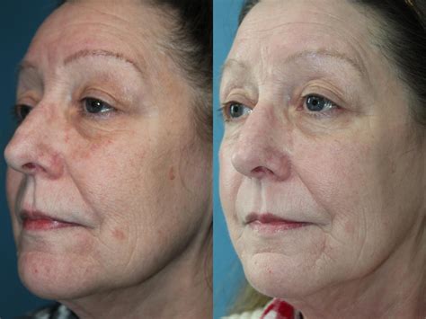 Advanced Laser & Skin Rejuvenation